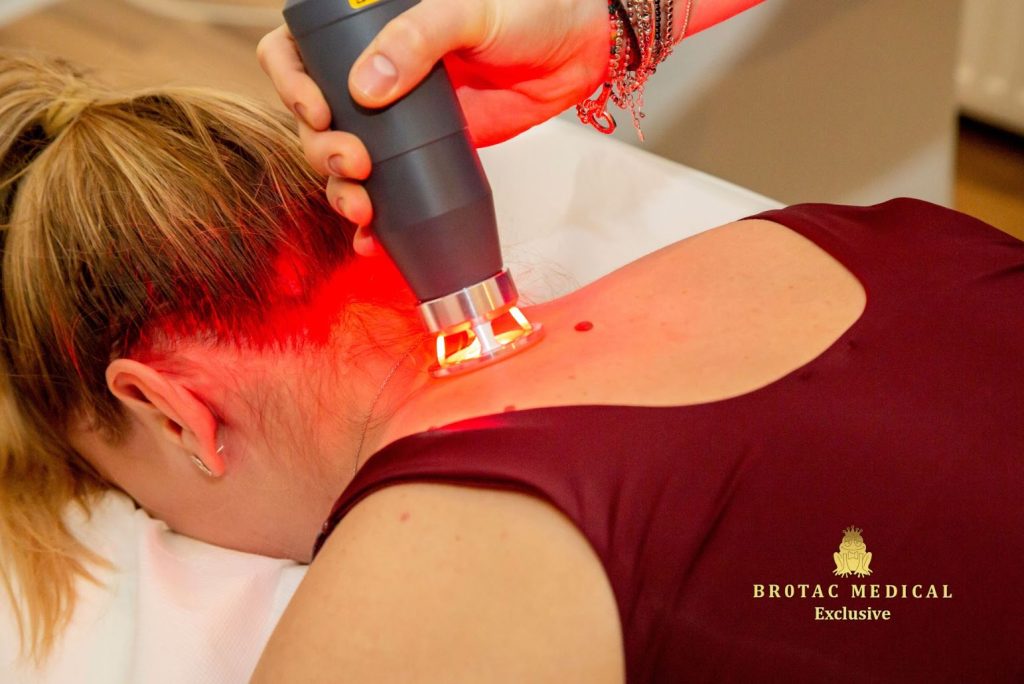 laserul de mare putere, brotac medical